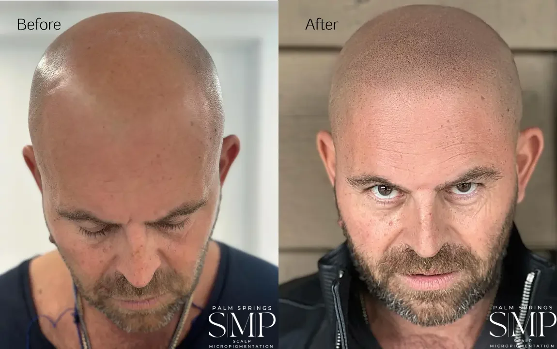 Before and After SMP Treatment