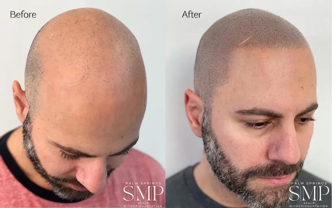 Male Pattern Baldness
